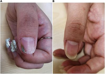 Case report: Novel use of the conventional method- chemical nail avulsion may be effective for treatment of green nail syndrome